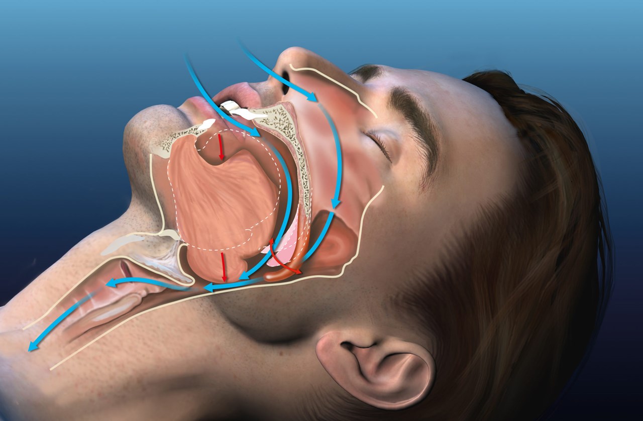 interrupted-breathing-during-sleep-a-widespread-disease-with-no-cure